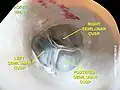 Aortic valve