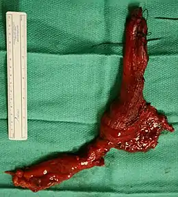  Image of a surgically removed esophagus due to late-stage Achalasia