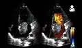 Echocardiogram showing atrial myxoma