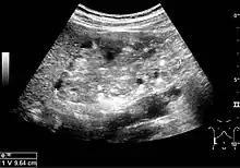 Figure 12. Patient with tuberous sclerosis and multiple angiomyolipomas in the kidney. Measurement of kidney length on the US image is illustrated by '+' and a dashed line.