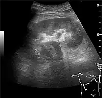 Figure 10. Solid tumor in the renal sinus seen as a hypoechoic mass, later found to be lymphoma. The '1' and '2' on the US image are reference points used for CT fusion (not shown).