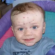 A child with chickenpox