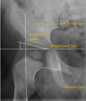 Normal hip.