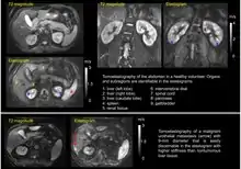 Tomoelastography of the abdomen of a healthy volunteer and a patient